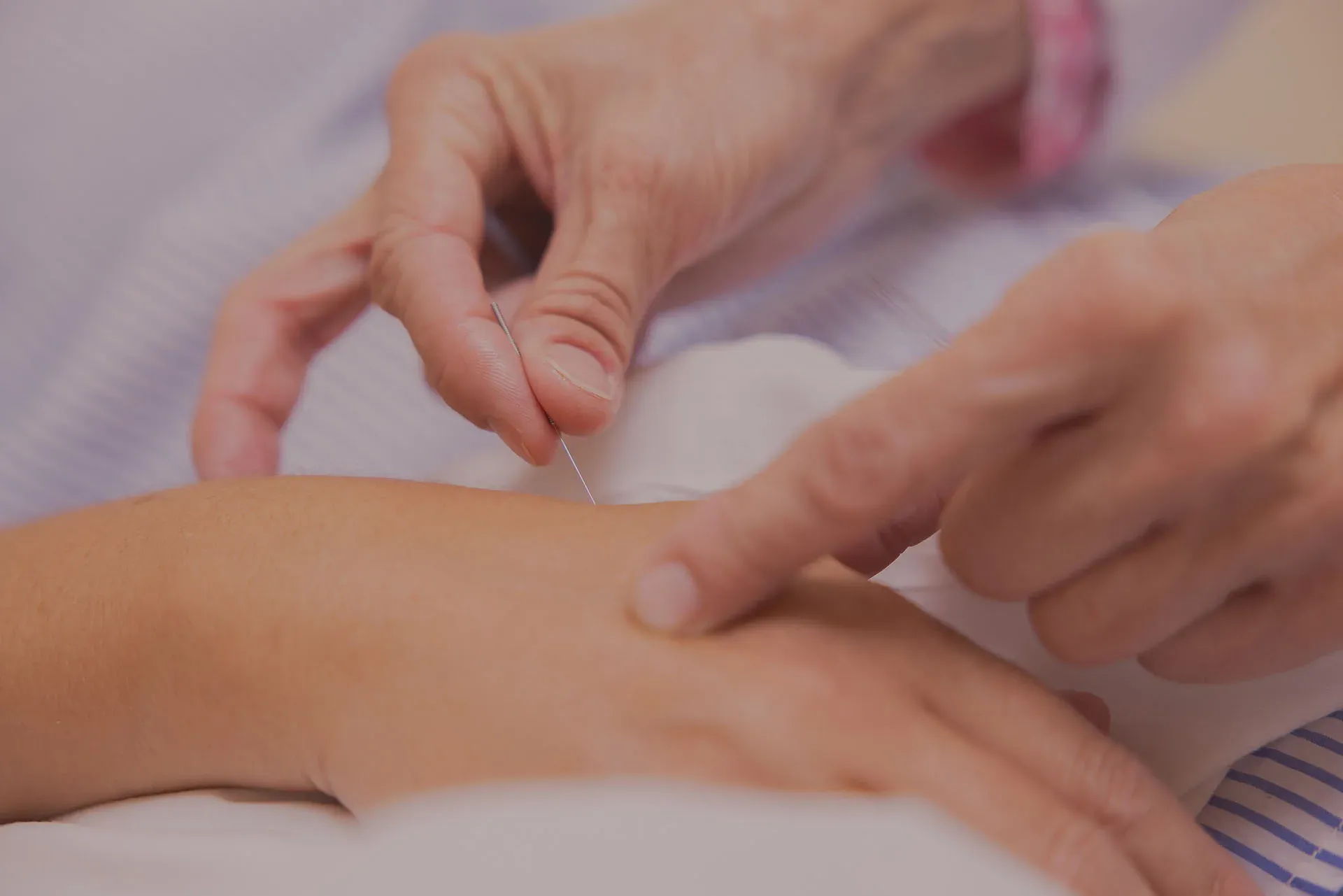 Acupuncture
